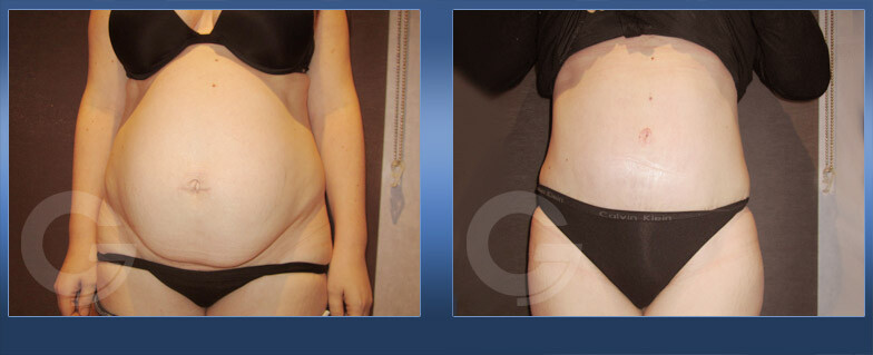 Before and After Result